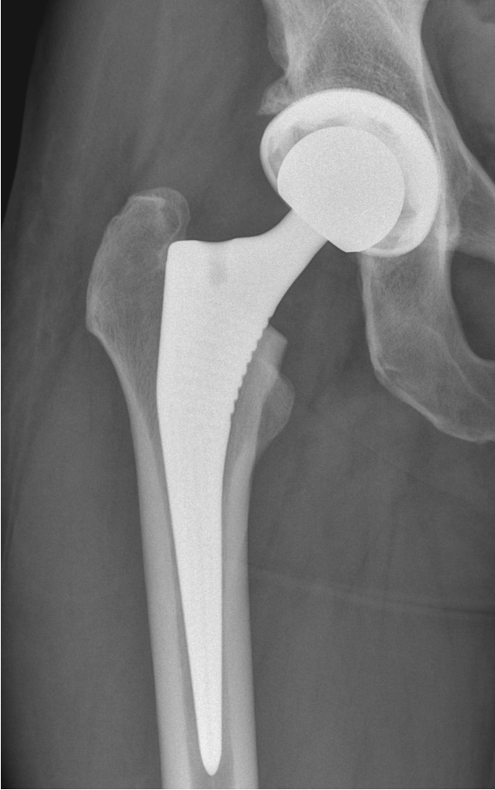 Postoperative radiograph of a total hip replacement