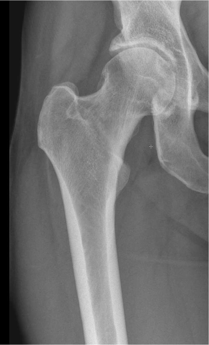 Preoperative radiograph of the hip