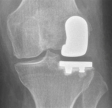 Laterale Knieteilprothese bei gestrecktem Knie