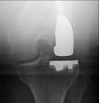Laterale Knieteilprothese bei gebeugtem Knie