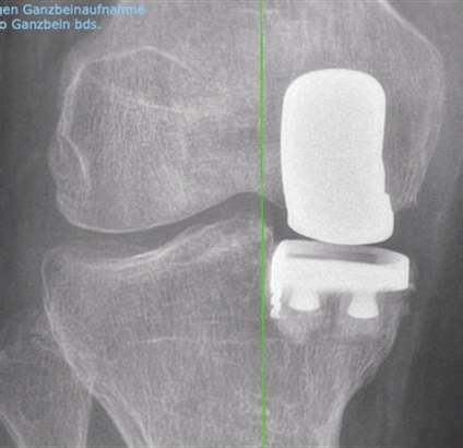 Mediale Knieteilprothese bei gestrecktem Knie
