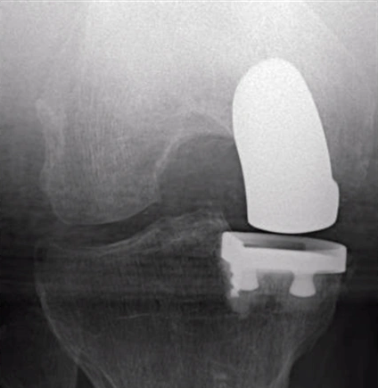 Mediale Knieteilprothese bei gebeugtem Knie