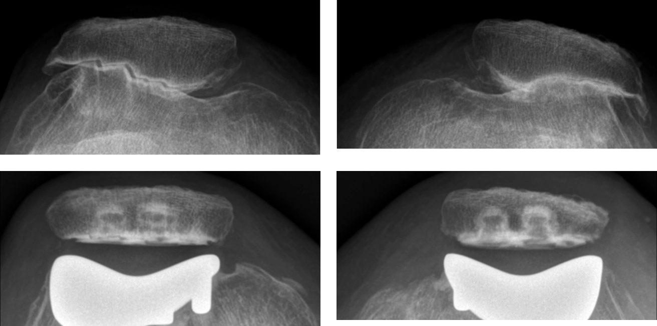 Beidseitige patellofemorale Arthrosen vor und nach Teilprothesenimplantation