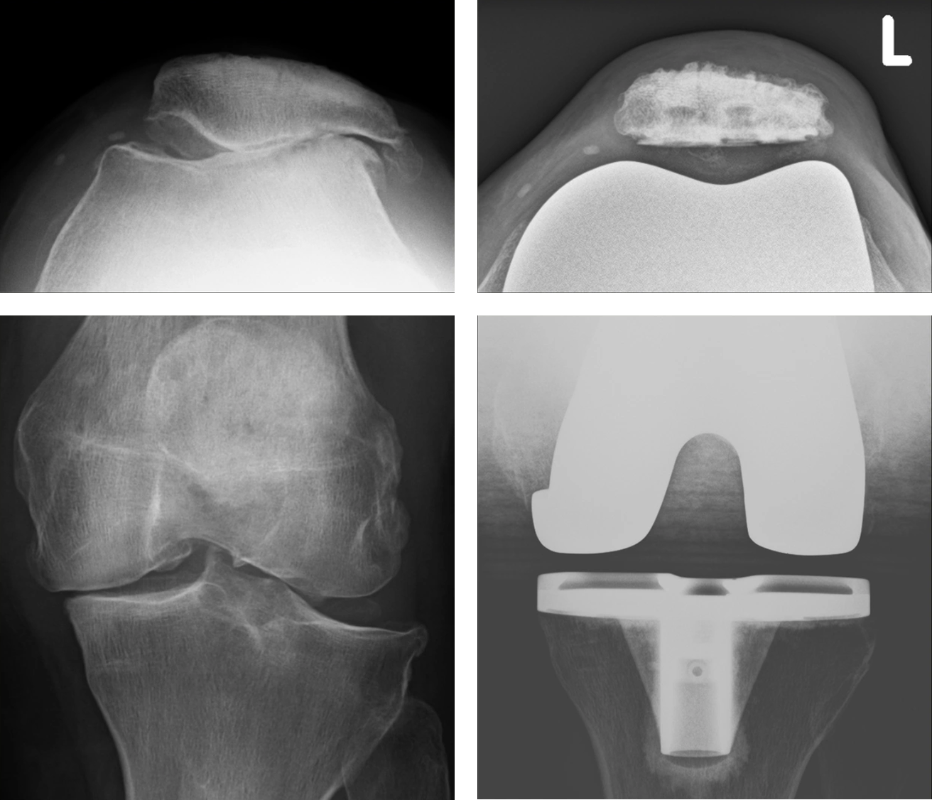 Knietotalprothese bei patellofemoraler Arthrose und Dysplasie